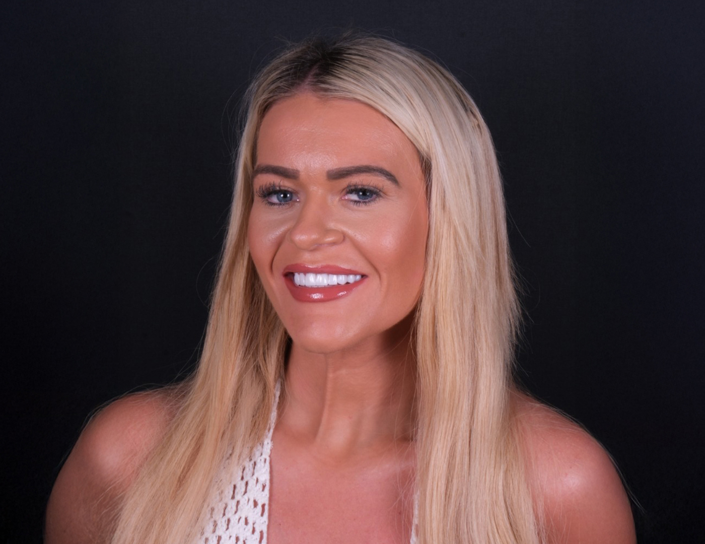 Hollywood smile Turkey case showing zirconium crown smile makeover for UK patient