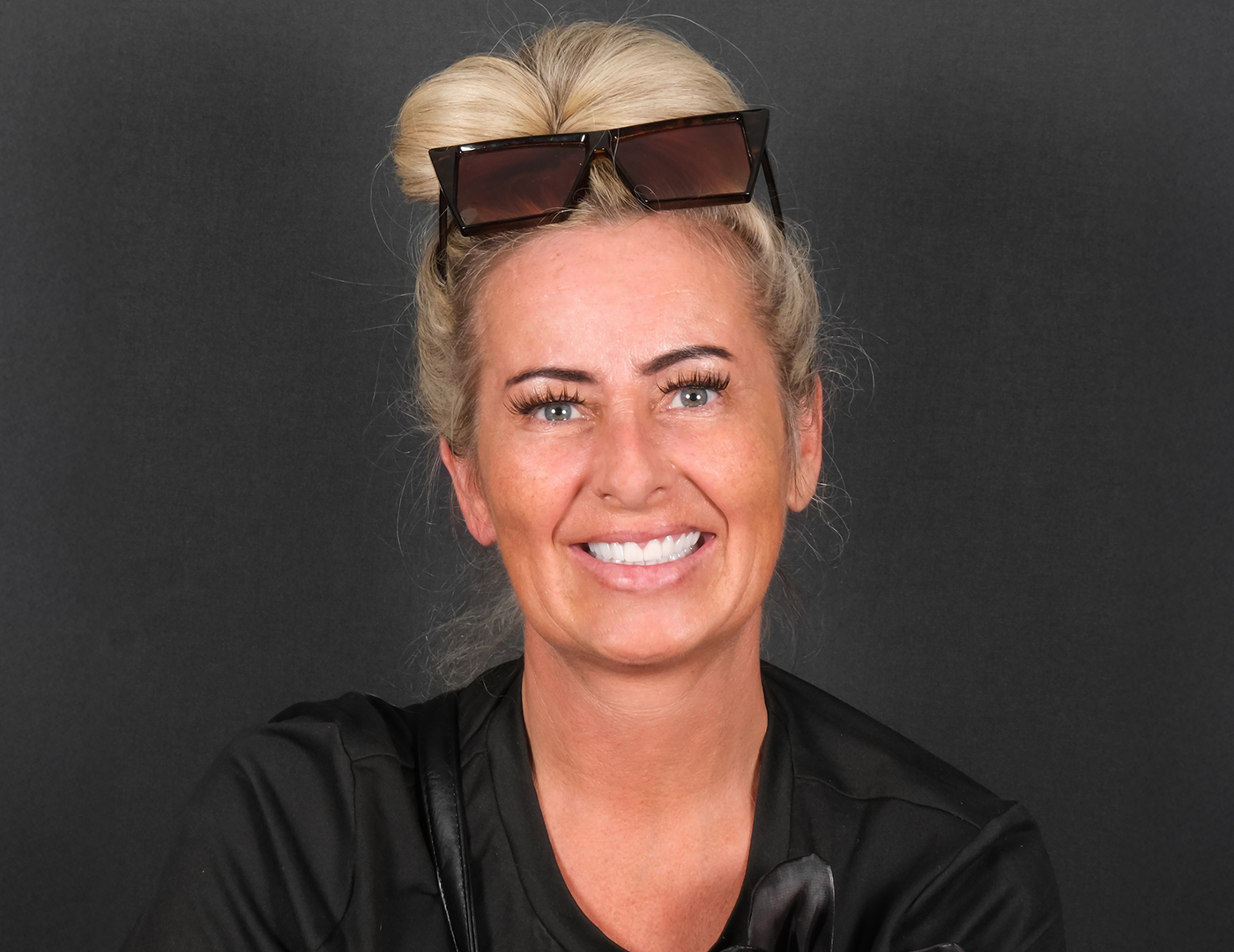 Zirconium crown smile makeover Turkey case with 25 crown restoration for UK patient